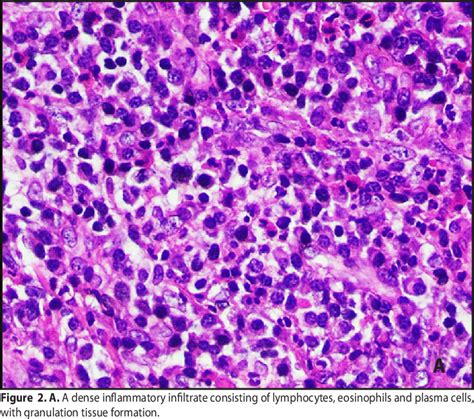 Figure 2 From Traumatic Ulcerative Granuloma With Stromal Eosinophilia
