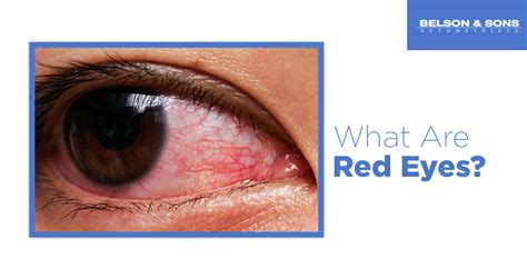 What Are Red Eyes Causes Symptoms And Treatment For Red Eyes
