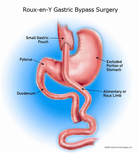 Gastric Bypass Dr Sorin Velici