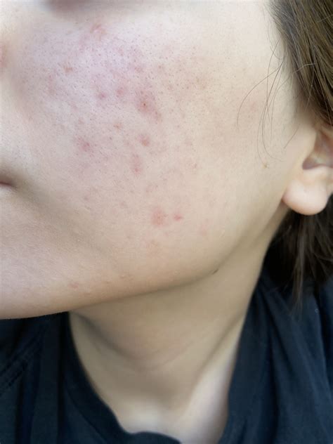 Red Hyperpigmentation Causes Treatment And More Justinboey