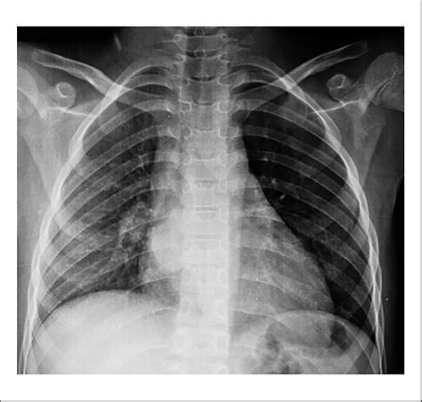 Chest X Ray Homogenous Area Of Increased Density With Regular Border