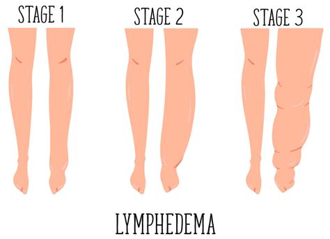 What Is Vein Disease And Lymphedema American Venous Forum Hot Sex Picture