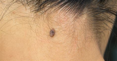 Warning Signs That You Need To Get Your Mole Checked Thomson