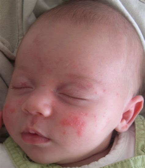 Baby Acne Cause Symptoms Treatment Home Remedies Sky