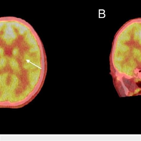 Axial Coronal Petct Fused Image Of The Brain Figure 2a Demonstrate