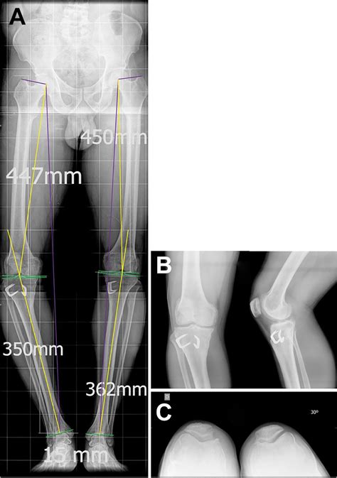 Dome Shaped Osteotomy For Revision Of Failed Closing Wedge High Tibial