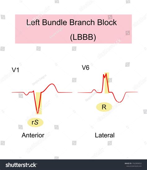 Left Bundle Branch Block Lbbb Ecg Vetor Stock Livre De Direitos