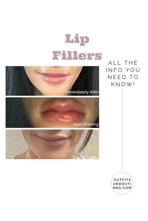 Lip Fillers 101 Before And After Pictures Outfits And Outings