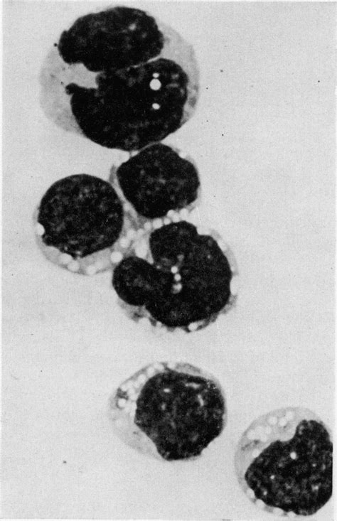 Mgg Stained Cells Showing Mononuclear Cells Two With Cleaved Nuclei