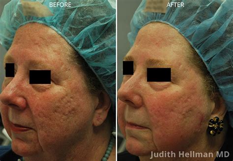 Co2 Laser Resurfacing Nyc Ultrapulse New York Skin Resurface