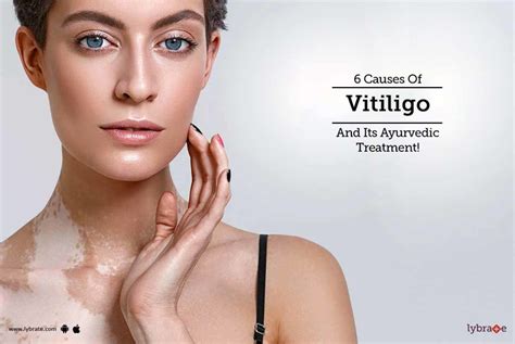 Causes Of Vitiligo And Its Ayurvedic Treatment By Dr Prasanna Kakunje Lybrate