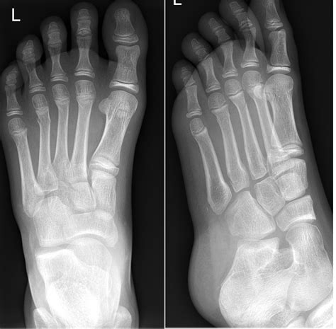 Fractures Foot
