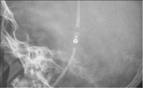 Lateral Skull X Ray Demonstrating A Right Frontal Approach