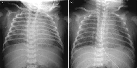 Neonatal Chest Imaging Radiology Key