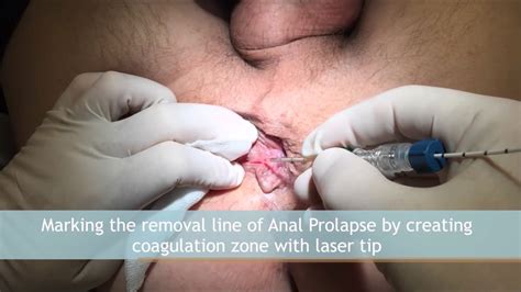 The good news is that it is possible to cure internal hemorrhoids naturally. Hemorrhoid Laser Treatment with neoV YouTube | Atak ...