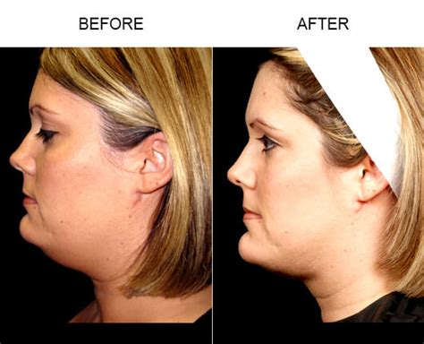 Face Liposuction Before And After