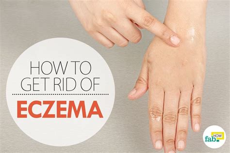 How To Get Rid Of Eczema Cure That Works Fab How