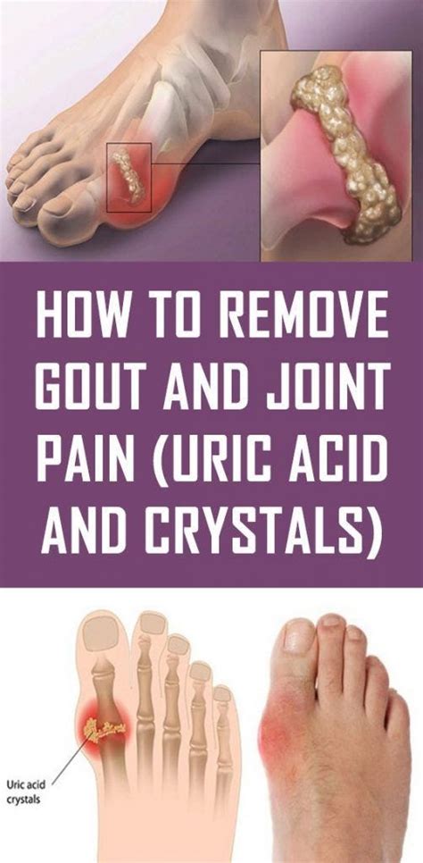The Best And Fastest Way To Remove Uric Acid Crystals And Stop Joint
