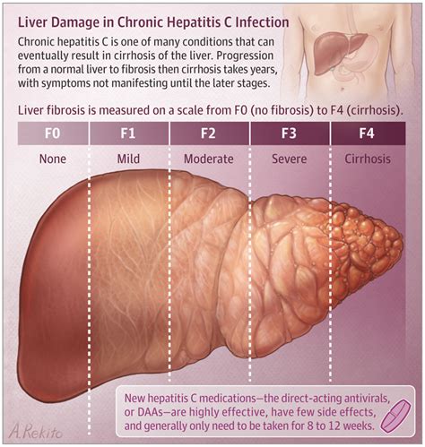 Bu konu;hepatit nedir,hepatit c ne dir tedavisi nelerdir hakkında bilgiler vermektedir karaciğerde meydana gelen iltihabı reaksiyon tıp bilimimde. Treating Hepatitis C | Infectious Diseases | JAMA | JAMA ...