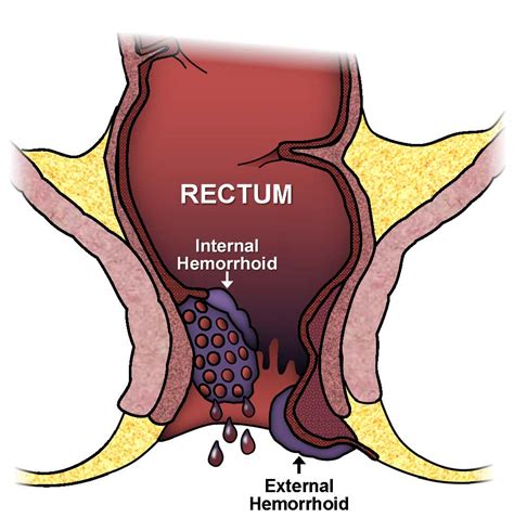 Causes, symptoms, diagnosis and natural and conventional treatments. Hemorrhoids: Expanded Version | ASCRS