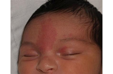 How To Treat An Infants Mongolian Spot