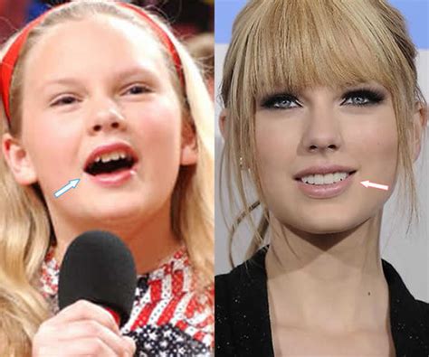 Taylor Swift Before And After Teeth Plastic Surgery