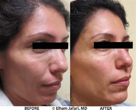 Liquid Facelift Cosmetic Treatments In Irvine Orange County