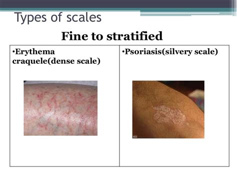 Secondary Skin Lesions
