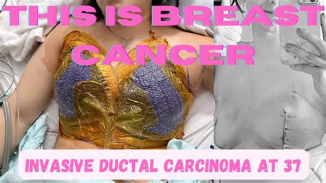 Breast Cancer At My Journey Bilateral Mastectomy With Tissue