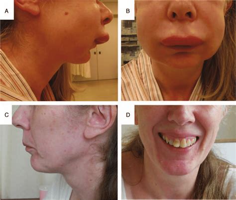 Angioedema Before And After