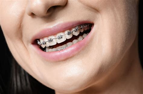 Qual A Importância De Se Ter Os Dentes Alinhados Em Um Tratamento Ortodôntico Ortoclube