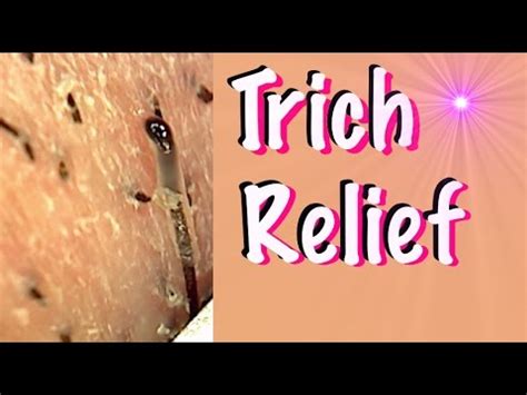 Can trichomoniasis go away on its own? Trich Relief Video - Help for Trichotillomania - YouTube