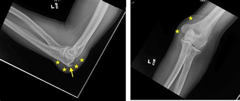 Cureus Olecranon Bursitis Secondary To Trauma