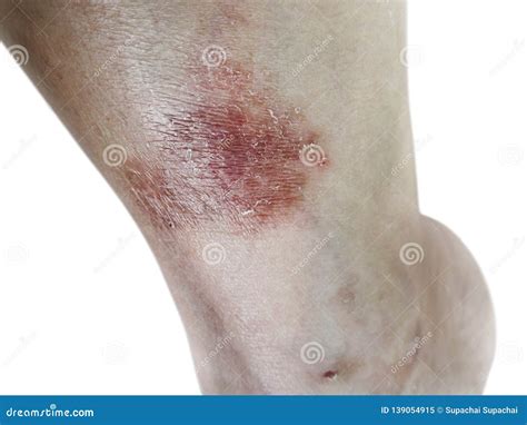 Rash Eczema On Woman Skin Foot Royalty Free Stock Photography