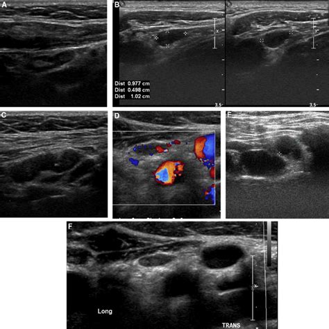 Normal Cervical Lymph Node Ultrasound