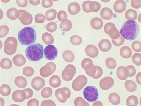 Filechronic Lymphocytic Leukemia Wikipedia