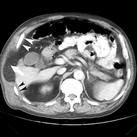 Abdominal Ct 11 Months Ago Revealed A Small Right Abdominal Wall Hernia