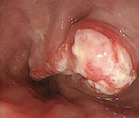 A Late Stage Squamous Cell Carcinoma Of The Esophagus In A 51 Year Old