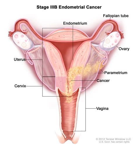 Endometrial Cancer Treatment Pdq Patient Version Nci