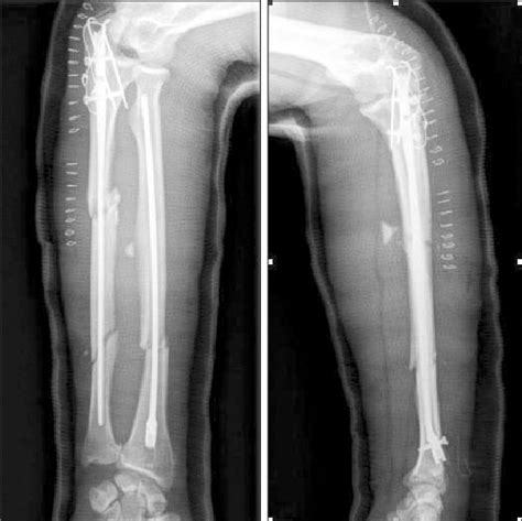 Postoperative Radiographs Showed Olecranon Fracture Fixed With Tension