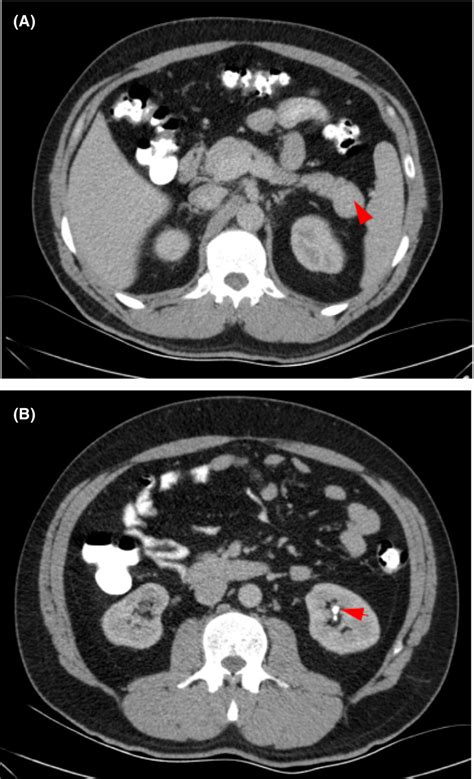 Multiple Endocrine Neoplasia Type 1 Familial Case In A Patient With