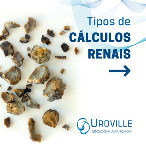 Densidade Cálculo Renal Uh