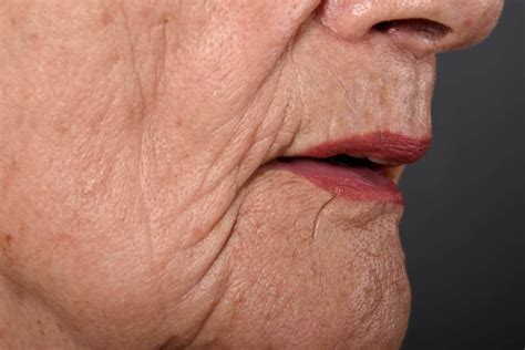Wrinkled Lips These Lines Usually Appear After Age 40 Mark Medical Care
