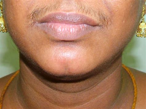 Excessive facial hair growth (female) webmd symptom checker helps you find the most common symptom combinations and medical conditions related to excessive facial hair growth (female). Women's Facial Hair Removal | HubPages