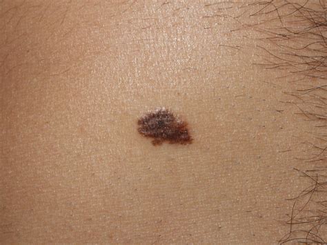 Immagini Melanoma E Tumori Della Pelle In Diversi Stadi