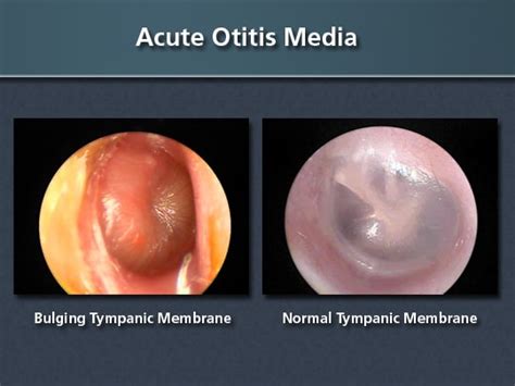 Acute Otitis Media Clinical Guidance For Diagnosis And Treatment