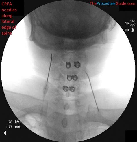 Fluoroscopic Guided Cervical Medial Branch Radiofrequency Ablation
