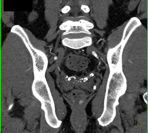 Seminal Vesicle Calcifications In A Diabetic Genitourinary Case