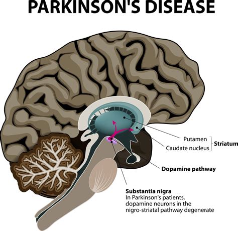 What Is Parkinsons Disease Causes Signs Symptoms And Treatments