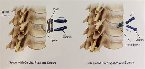 Cervical Spinal Fusion Surgery